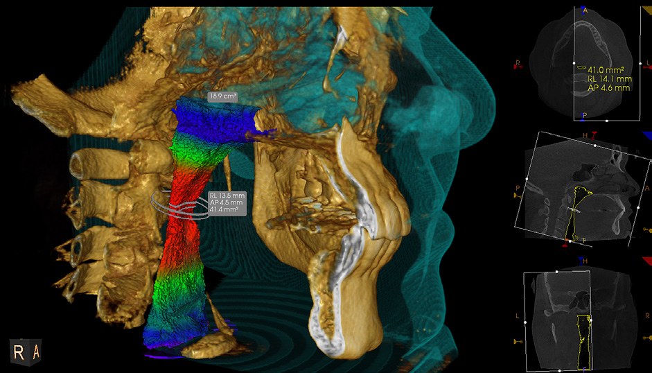 CS Airway 3D analysis on the Carestream CS 9600, showing the upper airway in colour with automatic measurements