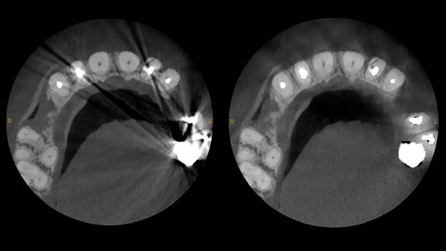 CS MAR metal artefact reduction on the CS 9600, shown with and without the filter