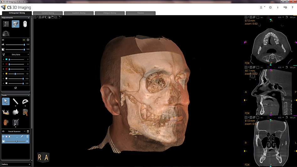 CS Face Scan on the Carestream CS 9600: a 3D facial image overlaid on the CBCT skull