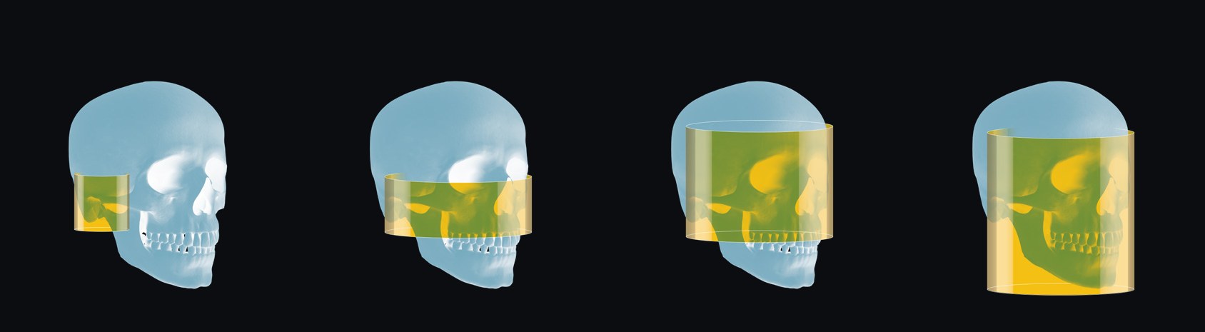 Carestream CS 9600 fields of view shown on a skull: 6 x 6, 16 x 6, 16 x 12 and 16 x 17 cm