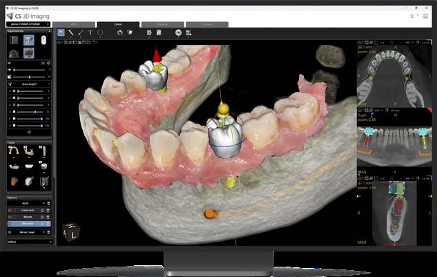 Full-arch implant planning with AI in CS 3D Imaging software, showing virtual teeth and implants on a CBCT model