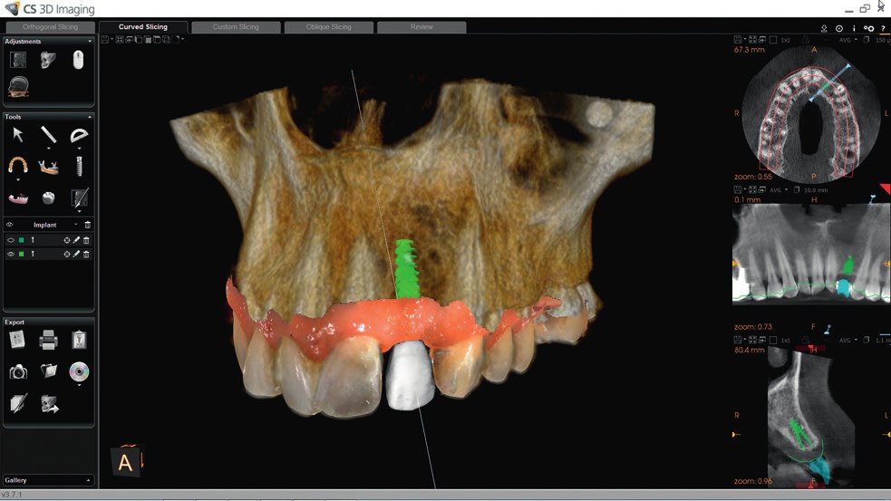 Crown-first implant planning in CS 3D Imaging: a virtual crown and implant placed on a CBCT 3D render