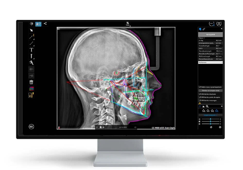 Cephalometric image with automatic tracing from the CS 9600 Scan Ceph module