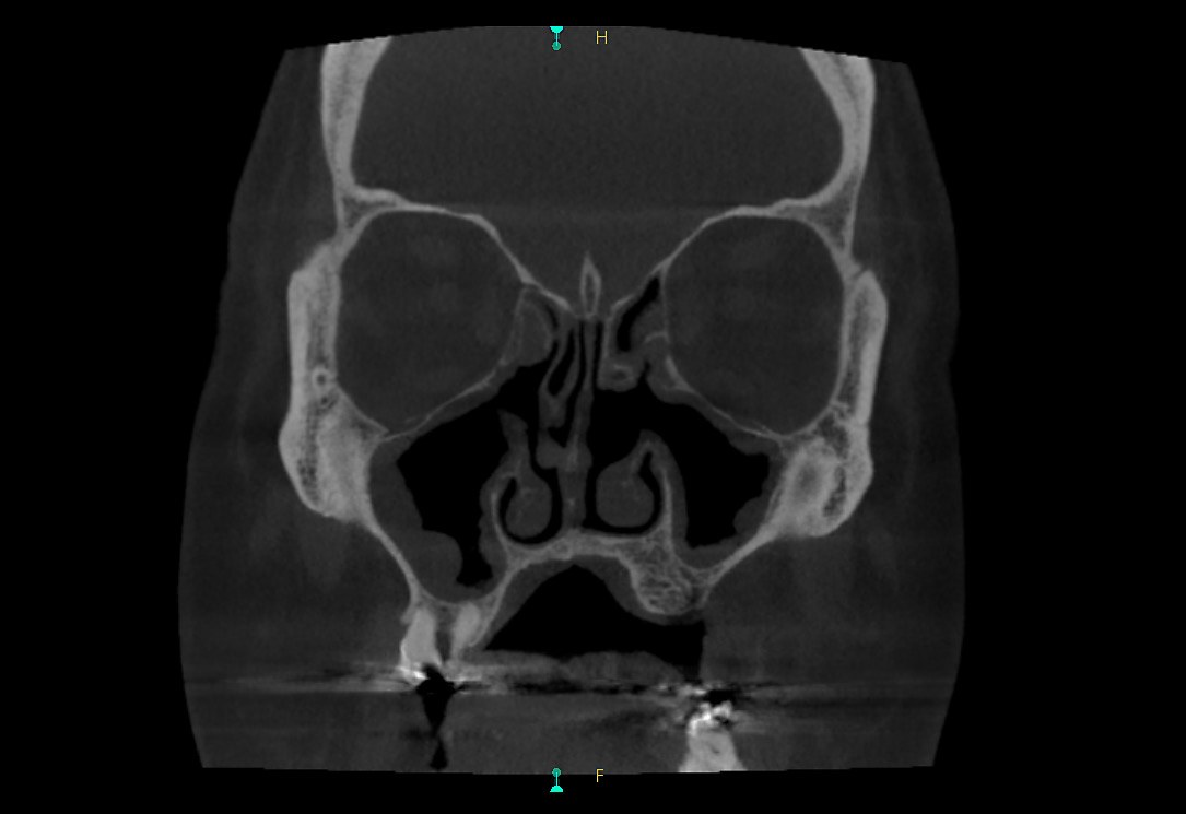 Coronal sinus CBCT image from the Carestream CS 9600