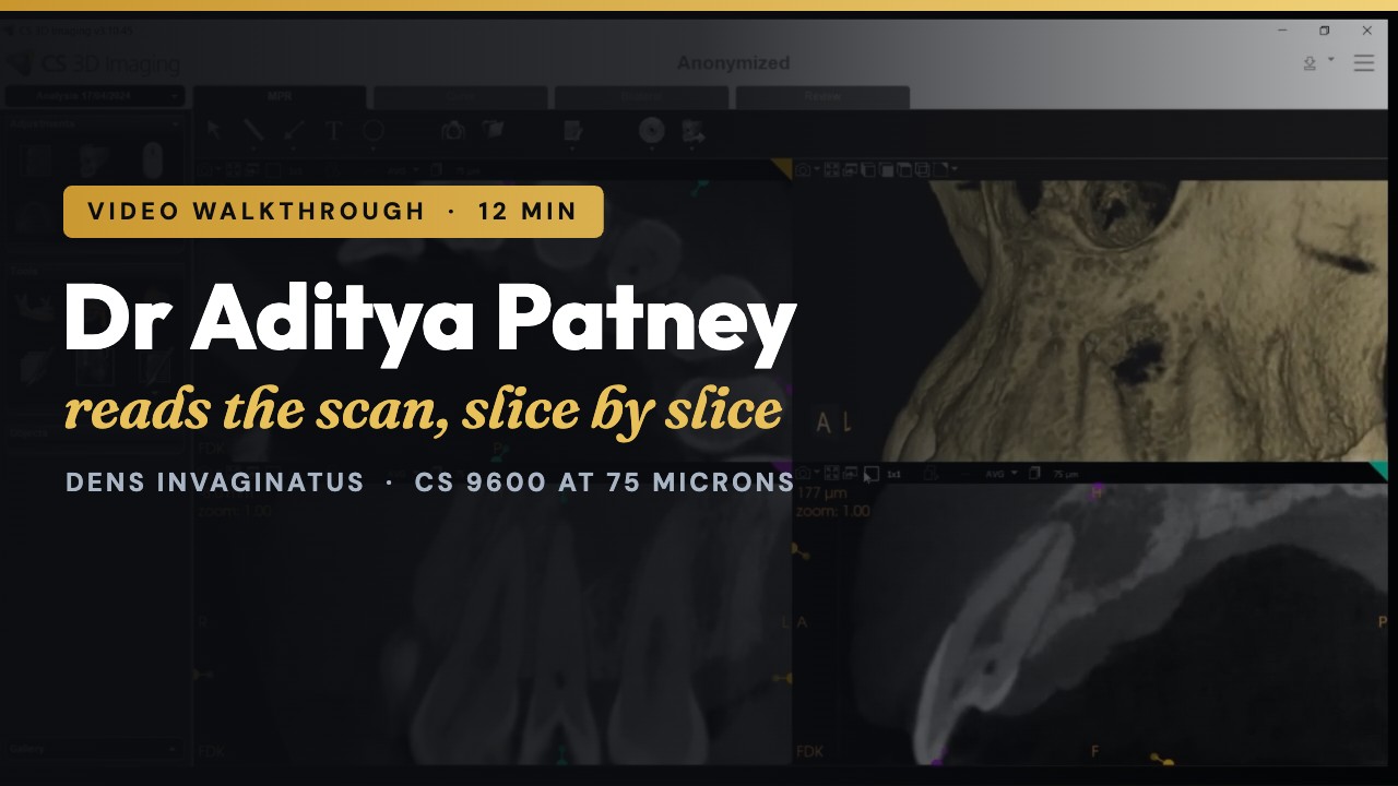 Dr Aditya Patney video walkthrough of a CS 9600 CBCT case