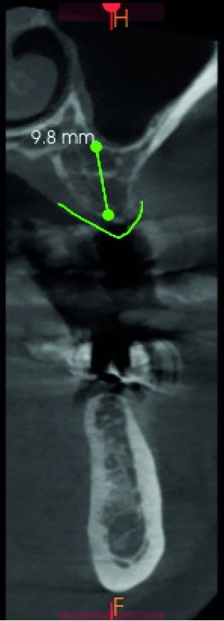Fig. 5 — AI auto implant placement in CS 3D Imaging Premium, cross-sectional view of the UL6 site