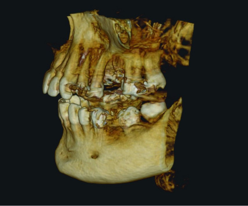 Fig. 1 — CBCT 3D render showing the edentulous UL6 region, the opposing teeth and the sinus region