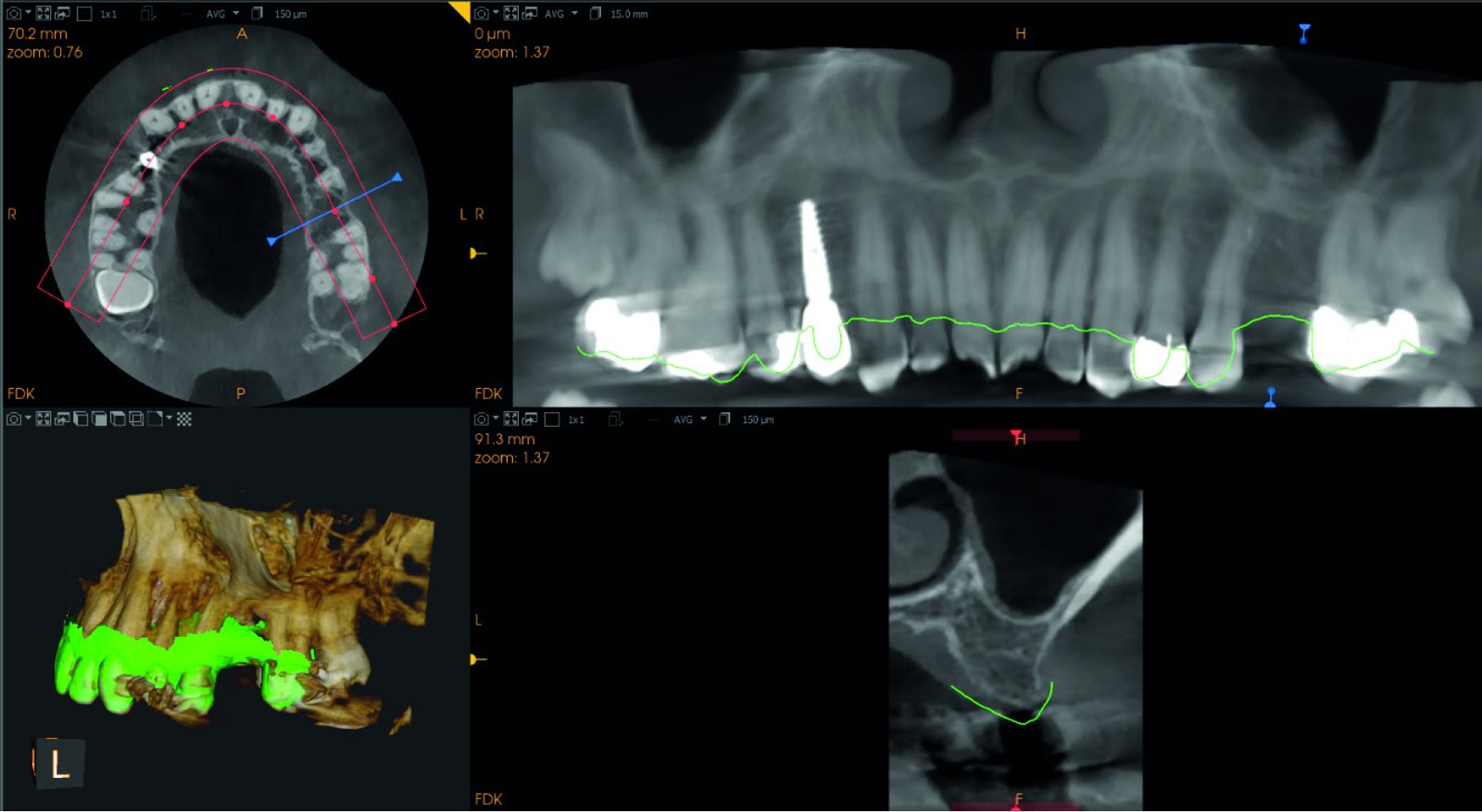 Fig. 3 — AI arch mapping in CS 3D Imaging Premium with the intraoral scan overlay showing the soft tissue