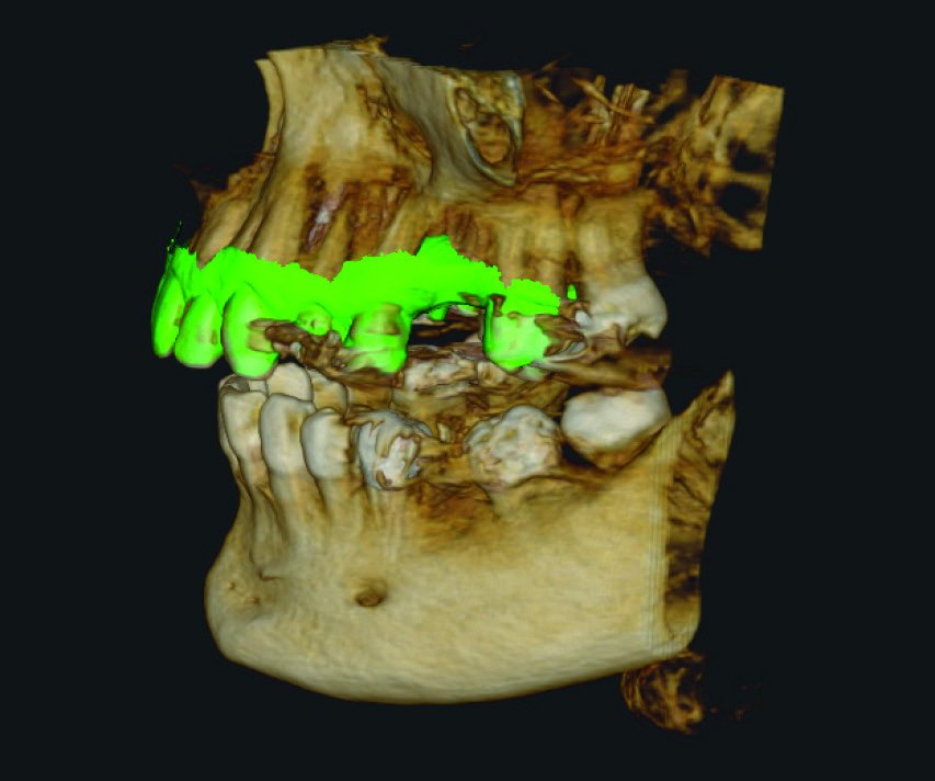 Fig. 2 — CBCT 3D render with the intraoral scan overlaid in green