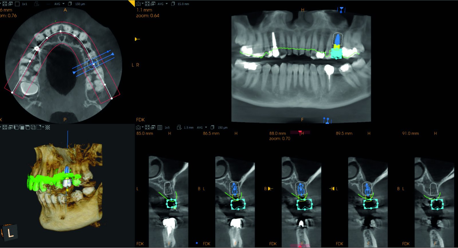 Fig. 4 — Cross-sections showing the planned implant position in relation to the ridge, angulation and maxillary sinus