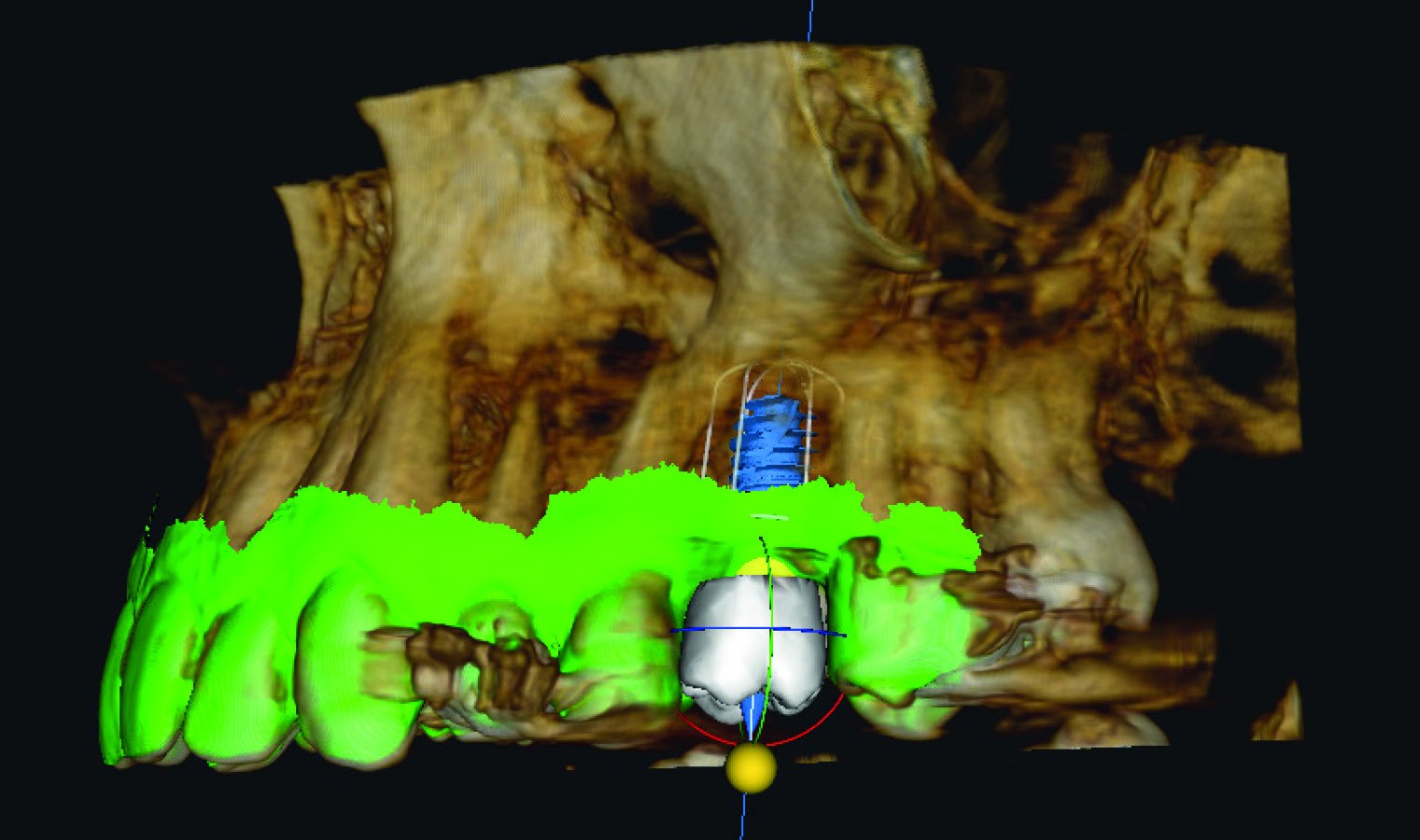 AI-planned crown and implant on a CBCT 3D render